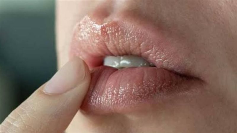  الجفاف والتشققات