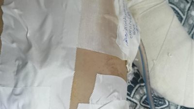 إنقاذ طفل مصاب بنزيف بالبطن والصدر بعد جراحة عاجلة بمستشفى دمياط العام