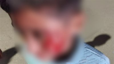 كلب شرس يلتهم وجه طفل بمنطقة الهضبة الوسطي بالمقطم 