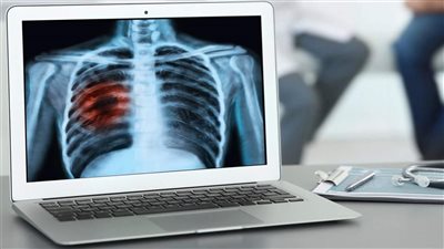 اكتشاف المحرك الرئيسي لتطور سرطان الرئة في مراحله المبكرة