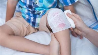 كمادات ماء ساقع وليس ثلج.. كيف تتعاملين مع حروق الأطفال في المنزل؟