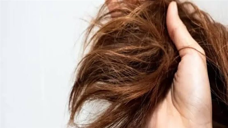 تساقط الشعر 