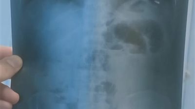 نجاح فريق طبي بمستشفى دمياط العام في إنقاذ مسن من فتق مختنق