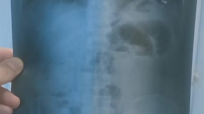 نجاح فريق طبي بمستشفى