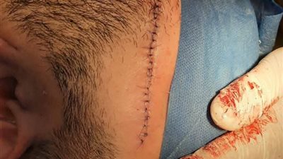 إنقاذ مريض بجرح قطعي في الوجه بمستشفى عزبة البرج بدمياط