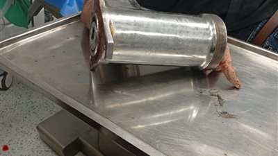 نزيف لا يتوقف.. مستشفى العجمي ينقذ شابا علقت يده في مفرمة لحوم