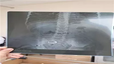 مناشدات للبحث عن طفل غادر مستشفى بالبحيرة والخاتم داخل بطنه