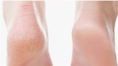 كعب ناعم بدون صالون .. حلول منزلية فعّالة لتشققات القدمين 	