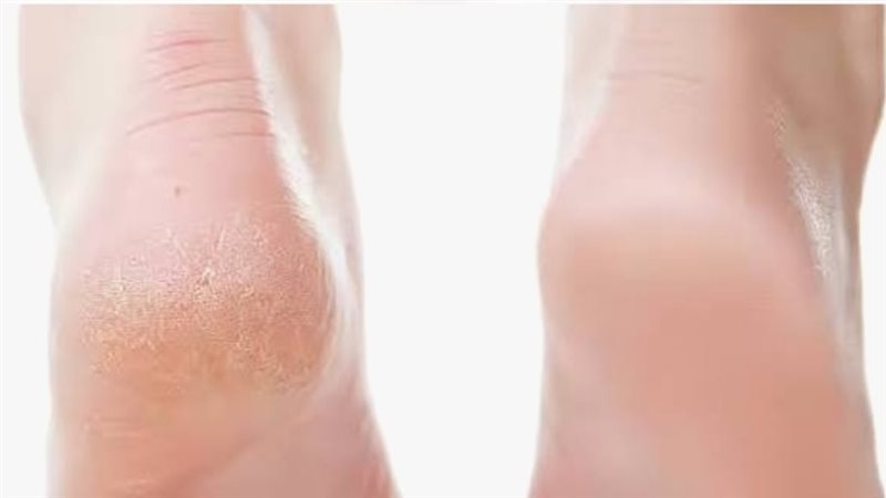 تشققات القدمين