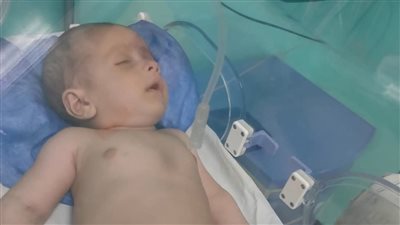 استعادة رضيع بالشرقية من الموت بعد محاولة اخته اطعامه تنرة توقفت بحلقه