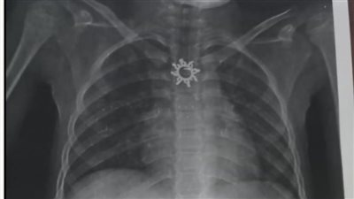 أستخرج سلسلة معدنية مدببة الأطراف ابتلعتها طفلة عمرها 9 سنوات بأبو كبير 