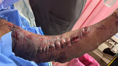 إنجاز طبي بسوهاج الجامعي.. الجراحات الميكروسكوبية تنقذ مصابين من بتر محقق