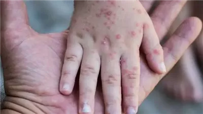استشاري طب الأطفال: الجدري المائي من أكثر الأمراض انتشارًا وتظهر أعراضه سريعًا