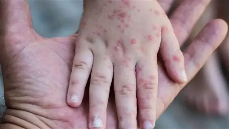  الجدري المائي 