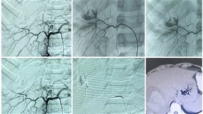 إنقاذ حياة طفل 12 عامًا بعد تمزق حاد بالكبد بمستشفى جامعة أسيوط