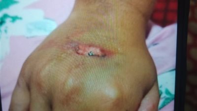 إصابة طفل بحروق متفرقة إثر تعذيبه بسبب قطف ثمرة رمان بالبحيرة