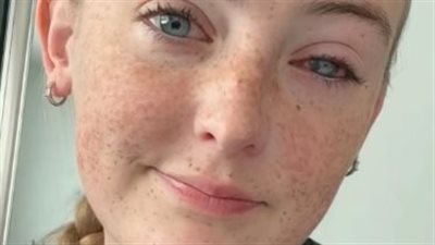 فتاة تصاب بالعمى بعد خطأ شائع في استخدام العدسات اللاصقة