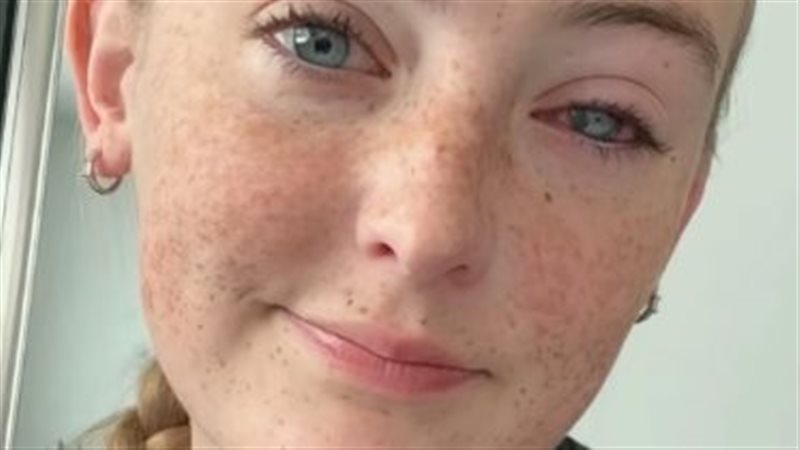 فتاة تصاب بالعمى