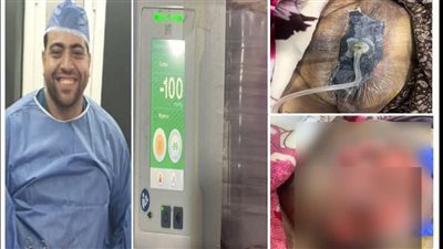 مستشفى دمياط العام يحقق طفرة علاجية بجهاز الفاكيوم للجروح المعقدة