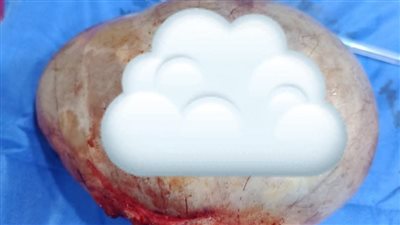 نجاح جراحة لإزالة كيس مبيضي عملاق بحجم 20 سم بمستشفى قويسنا بالمنوفية