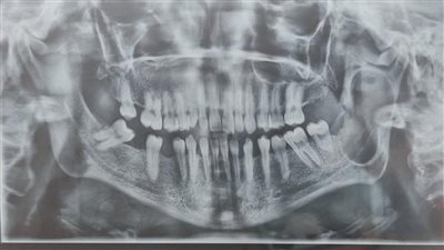 إنجاز طبي يحسب لدمياط.. جراحة معقدة تنهي معاناة مريض بورم بالفك السفلي