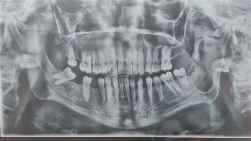 نجاح جراحة دقيقة