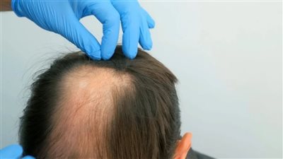 أمل جديد للصلع.. علاج جديد يسرع نمو الشعر بمقدار 5 مرات