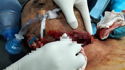 نجاح جراحة معقدة لإنقاذ حياة مواطن من إصابة قاتلة في الرقبة بالبحيرة