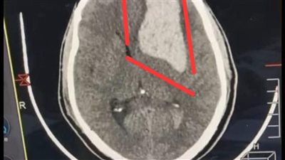 نجاح طبي بدمياط.. إنقاذ شاب من نزيف دماغي حاد بعد حادث طريق