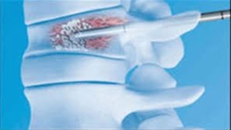 حقن الأسمنت الطبي