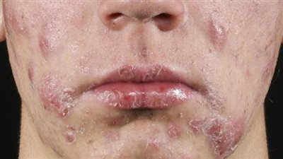 تعرف على أسباب ظهور حب الشباب.. وكشف حقائق الخرافات