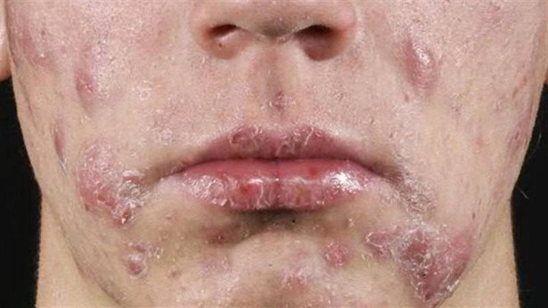 حب الشباب - صورة