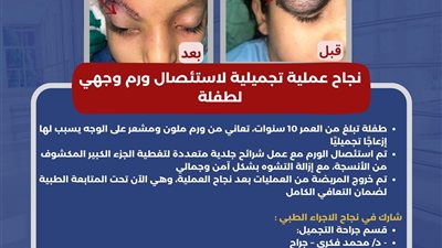 أطباء مستشفى أبوقير يحولون حياة طفلة للأفضل بعد إزالة تشوهات بوجهها