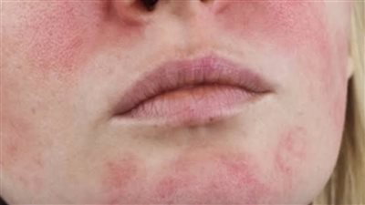 الأكزيما الدهنية في الوجه.. كيف تسيطرين عليها؟ نصائح خبيرة العناية بالبشرة|خاص