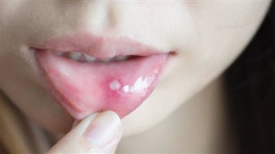 مكونات بسيطة في مطبخك للتخلص من فطريات الفم واللسان  