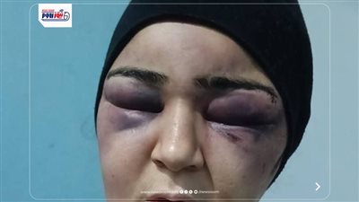 إصابات بالغة بالوجه واليدين.. زوج يعتدي بالضرب على زوجته بالفيوم