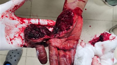 إنجاز طبي بمستشفي سوهاج.. إنقاذ شاب تعرض لبتر كامل بإصبع الإبهام 