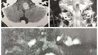 نجاح طبي بجامعة أسيوط في استئصال ورم دموي من جذع المخ لشاب