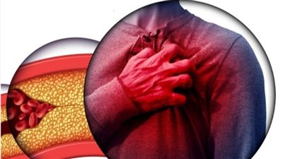 5 أسباب لتصلب الشرايين وأعراضه وطرق الوقاية للحفاظ على صحة القلب