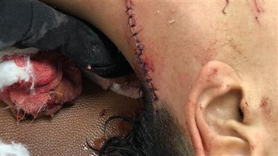 مستشفى العجمي ينقذ طالبا بالإعدادية تعدى عليه أشخاص وأصابوه بجروح مميتة