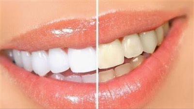 طرق تبييض الأسنان في المنزل .. نتائج حقيقية بمكونات متوفرة 	