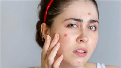 حب الشباب في الشتاء ليس صدفة… هذه الأسباب الخفية وكيف توقفينه