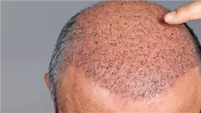 هل زراعة الشعر للرجل أو المرأة حلال شرعا؟ الشيخ أشرف عبد الجواد يجيب