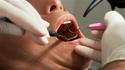 هل تؤثر الأسنان المزروعة على صحة المضمضة في الوضوء؟