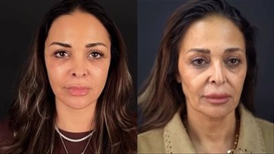بعد خضوع الفنانة داليا البحيري لعملية شد الوجه ..ما الحكم الشرعي؟