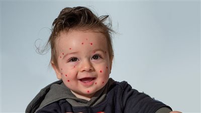 أمجد الحداد يوضح حقيقة مرض الجدري المائي وانتشاره بين الأطفال| خاص 