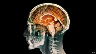 دراسة طبية تكشف عن مرونة مذهلة للدماغ في حالة نادرة