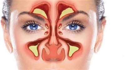 كيف تحمي الجيوب الأنفية من التقلبات الجوية والأتربة؟.. دليل وقائي شامل