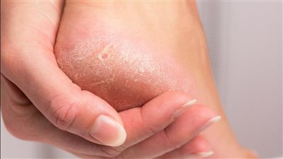 في فصل الصيف.. 7 خطوات فعالة للعناية بالقدمين والوقاية من الروائح والتشققات