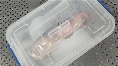 حادث مأساوي فى مدينة اشمون بالمنوفية يسفر عن بتر ذراع طفلة